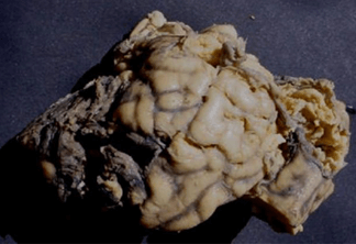 Ramollissement et n&eacute;crose du cortex c&eacute;r&eacute;bral 